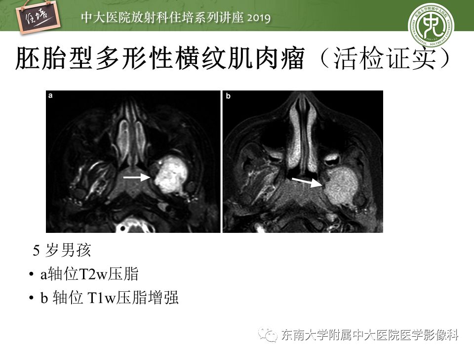 【PPT】颈部间隙的影像解剖及诊断思路