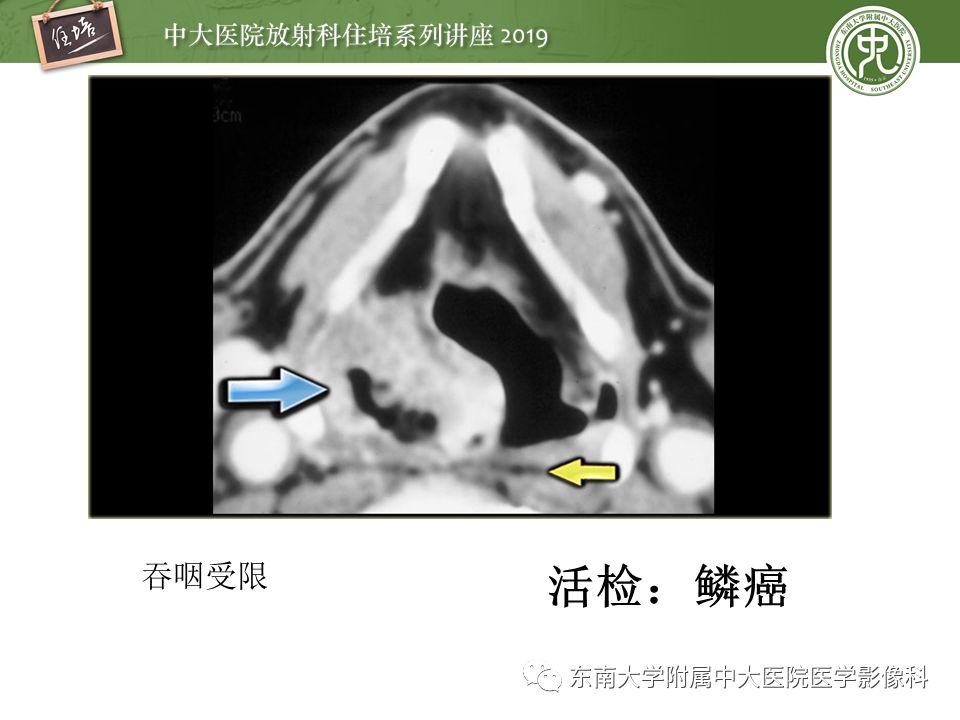 【PPT】颈部间隙的影像解剖及诊断思路