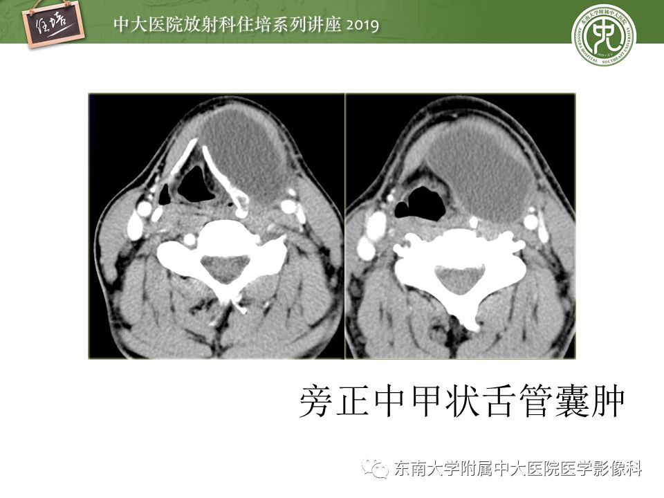 【PPT】颈部间隙的影像解剖及诊断思路