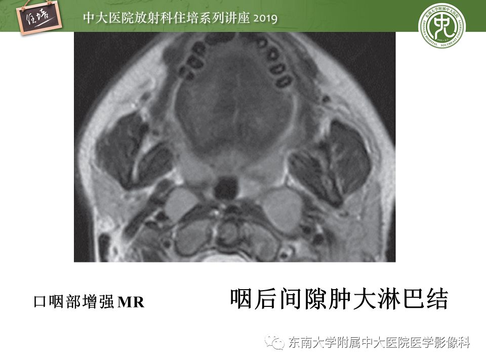 【PPT】颈部间隙的影像解剖及诊断思路