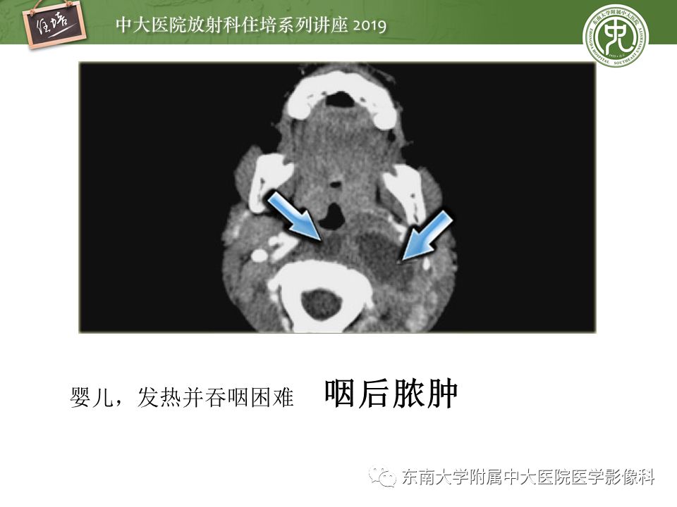 【PPT】颈部间隙的影像解剖及诊断思路