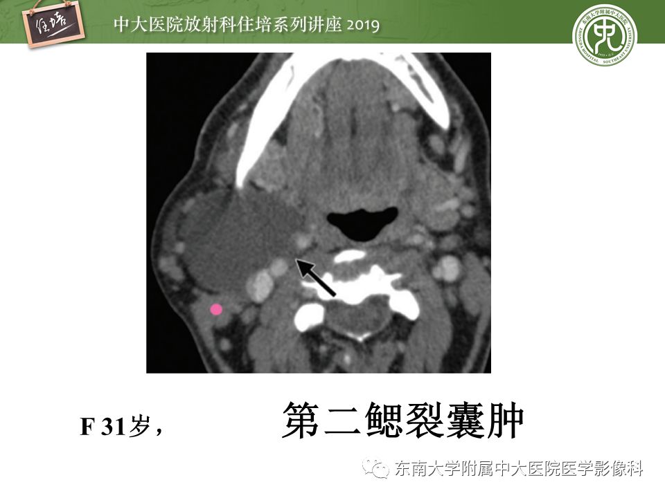 【PPT】颈部间隙的影像解剖及诊断思路