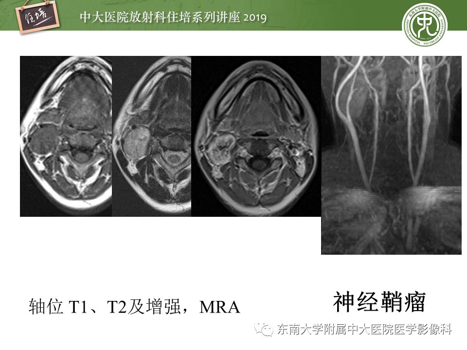【PPT】颈部间隙的影像解剖及诊断思路