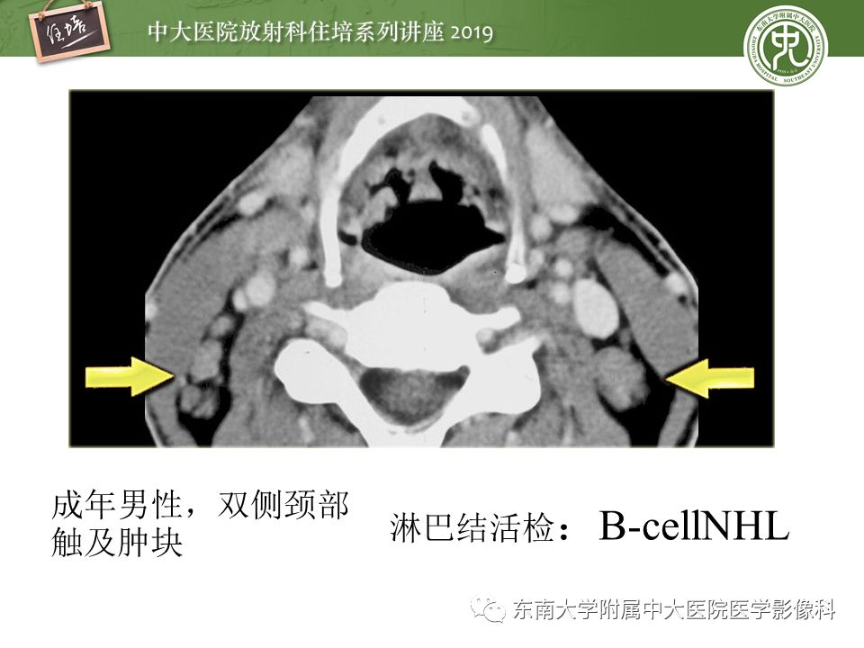 【PPT】颈部间隙的影像解剖及诊断思路