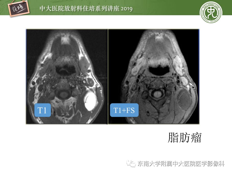 【PPT】颈部间隙的影像解剖及诊断思路