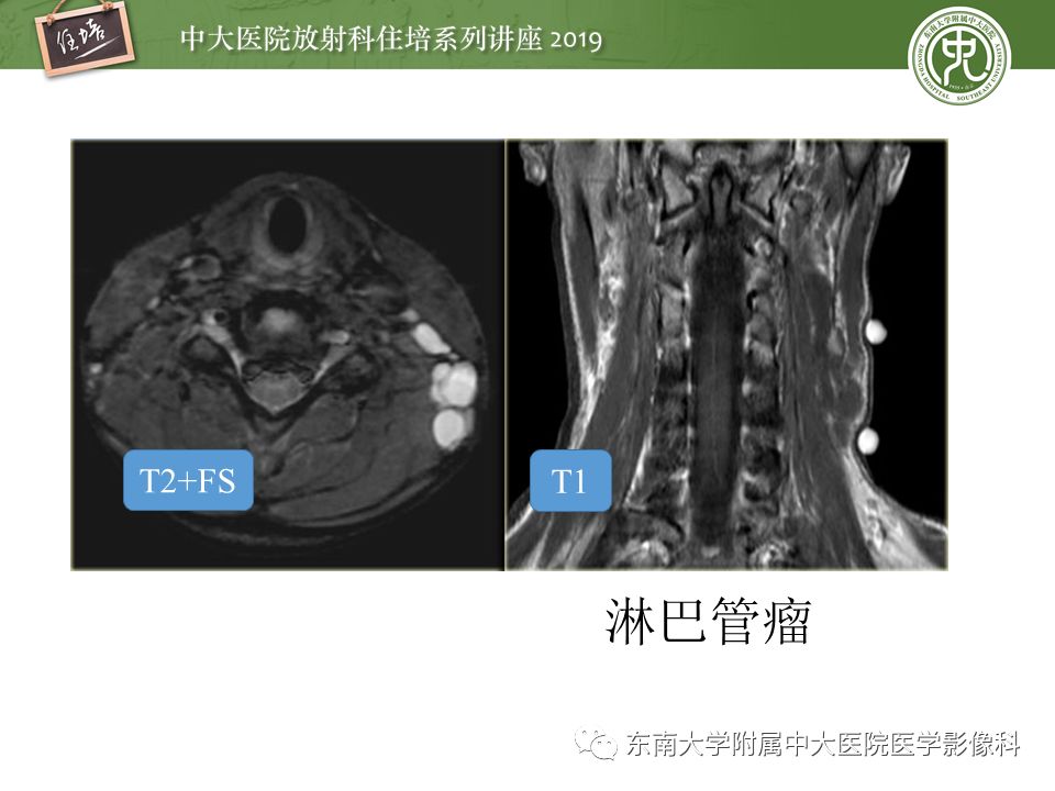 【PPT】颈部间隙的影像解剖及诊断思路
