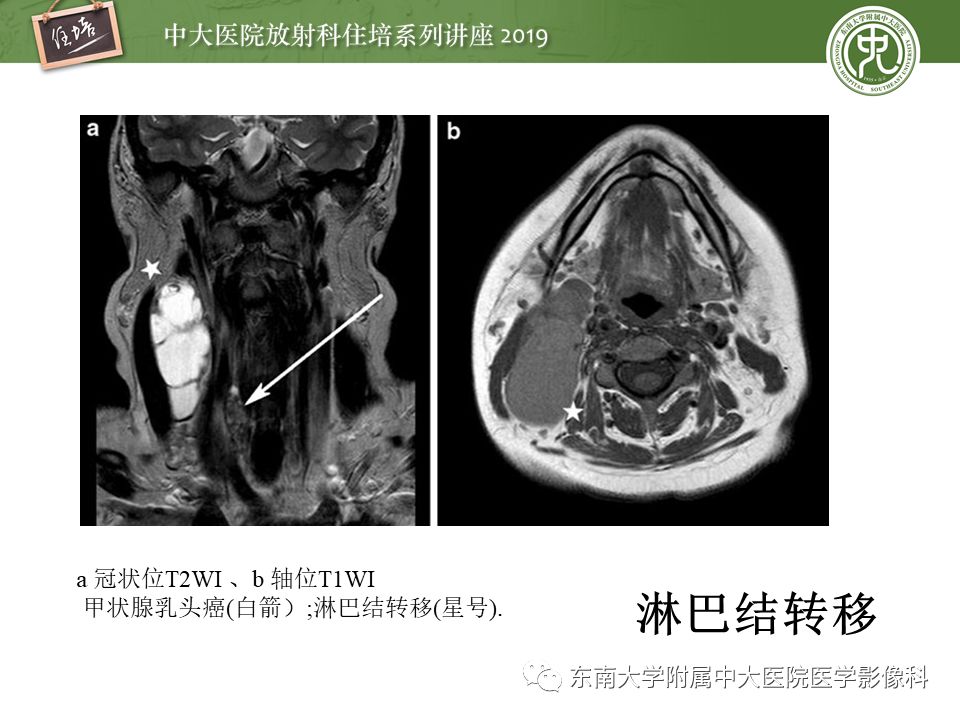 【PPT】颈部间隙的影像解剖及诊断思路