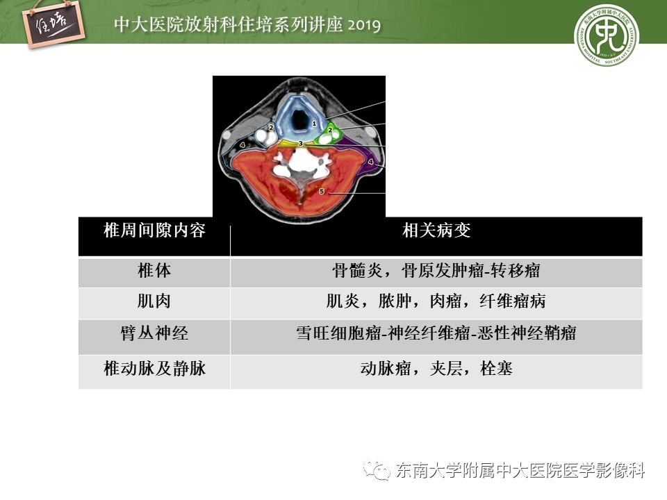 【PPT】颈部间隙的影像解剖及诊断思路