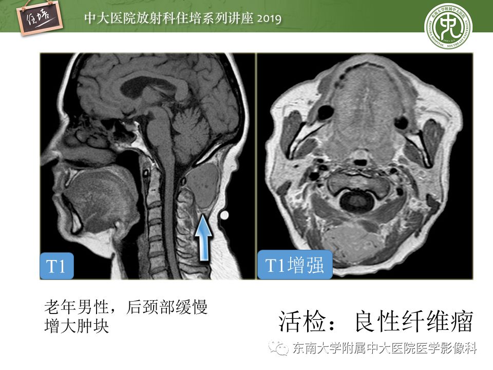 【PPT】颈部间隙的影像解剖及诊断思路