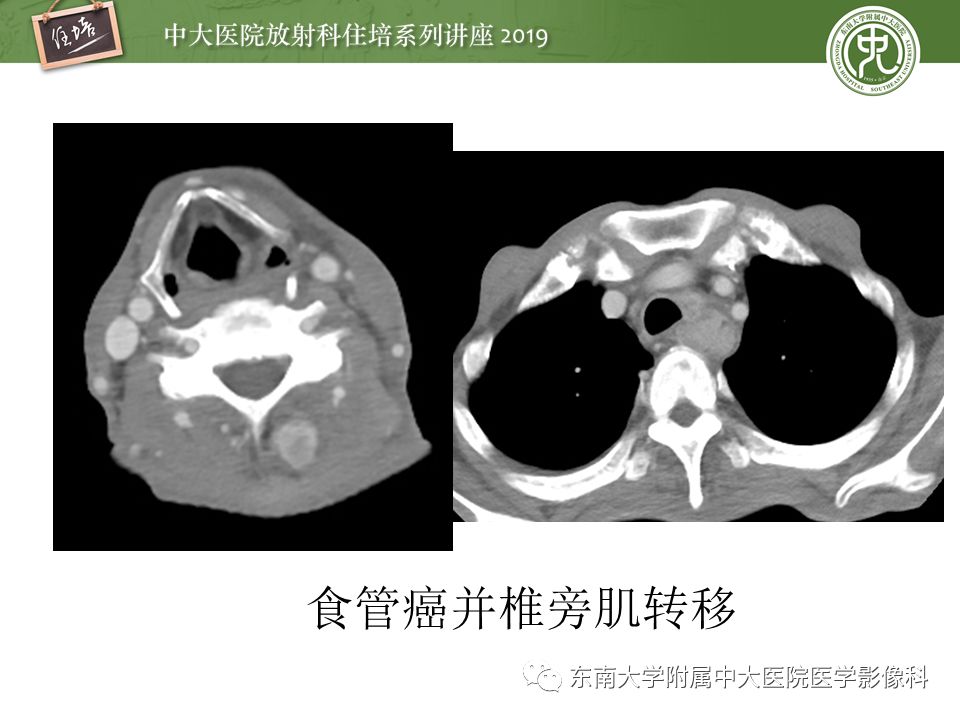 【PPT】颈部间隙的影像解剖及诊断思路