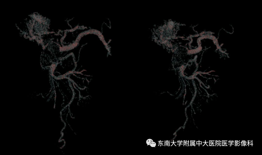 【病例】门静脉海绵样变性1例CT影像