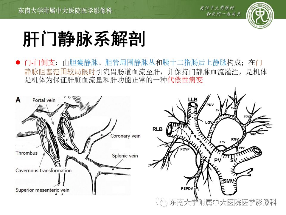 【病例】门静脉海绵样变性1例CT影像