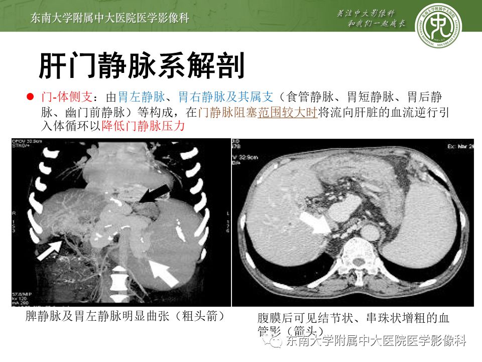【病例】门静脉海绵样变性1例CT影像