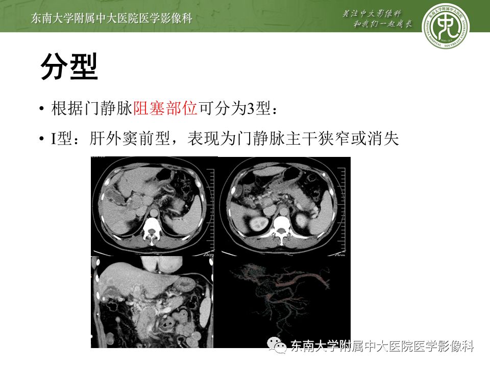 【病例】门静脉海绵样变性1例CT影像