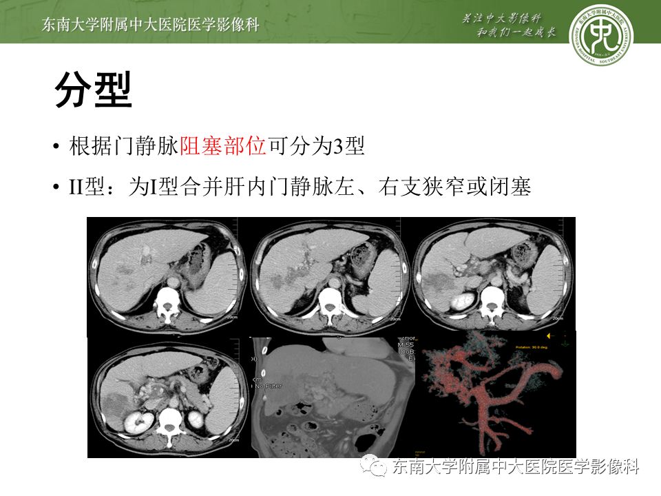 【病例】门静脉海绵样变性1例CT影像
