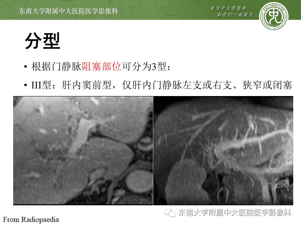 【病例】门静脉海绵样变性1例CT影像