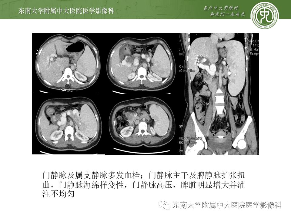 【病例】门静脉海绵样变性1例CT影像