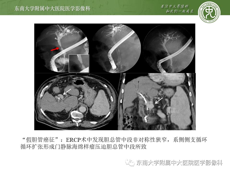 【病例】门静脉海绵样变性1例CT影像