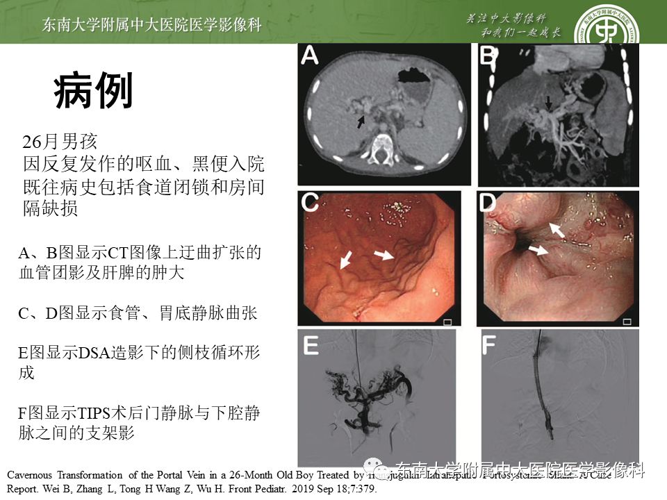 【病例】门静脉海绵样变性1例CT影像