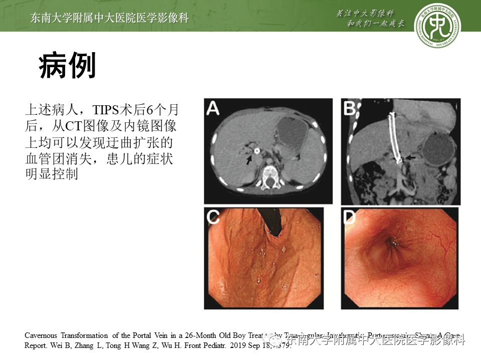 【病例】门静脉海绵样变性1例CT影像