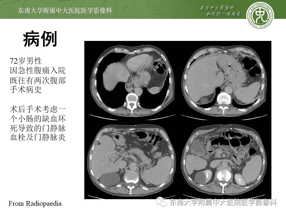 【病例】门静脉海绵样变性1例CT影像