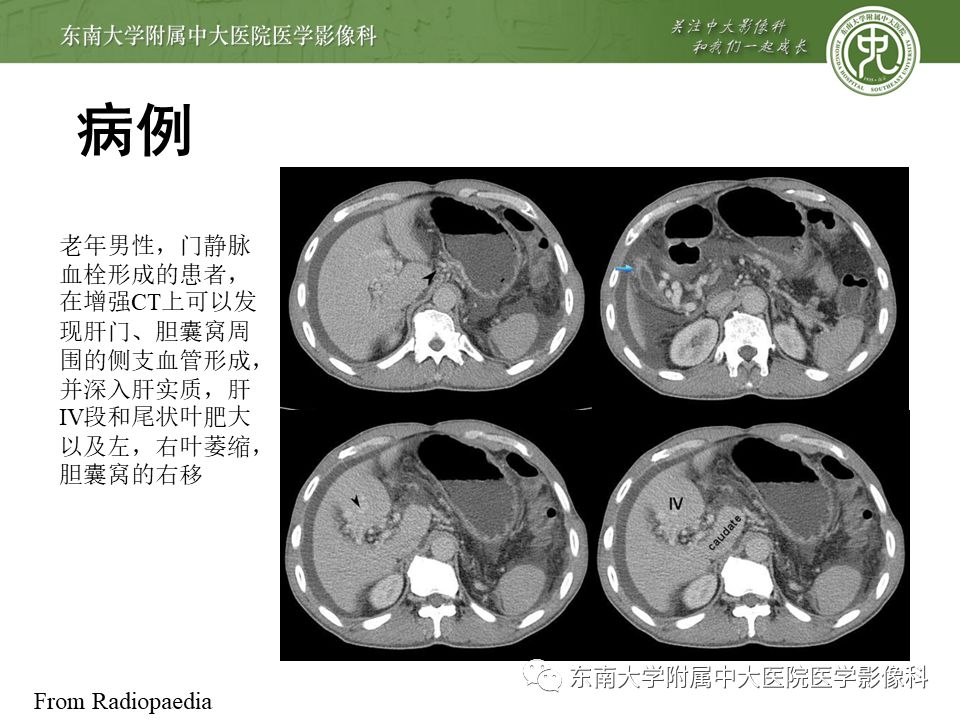 【病例】门静脉海绵样变性1例CT影像