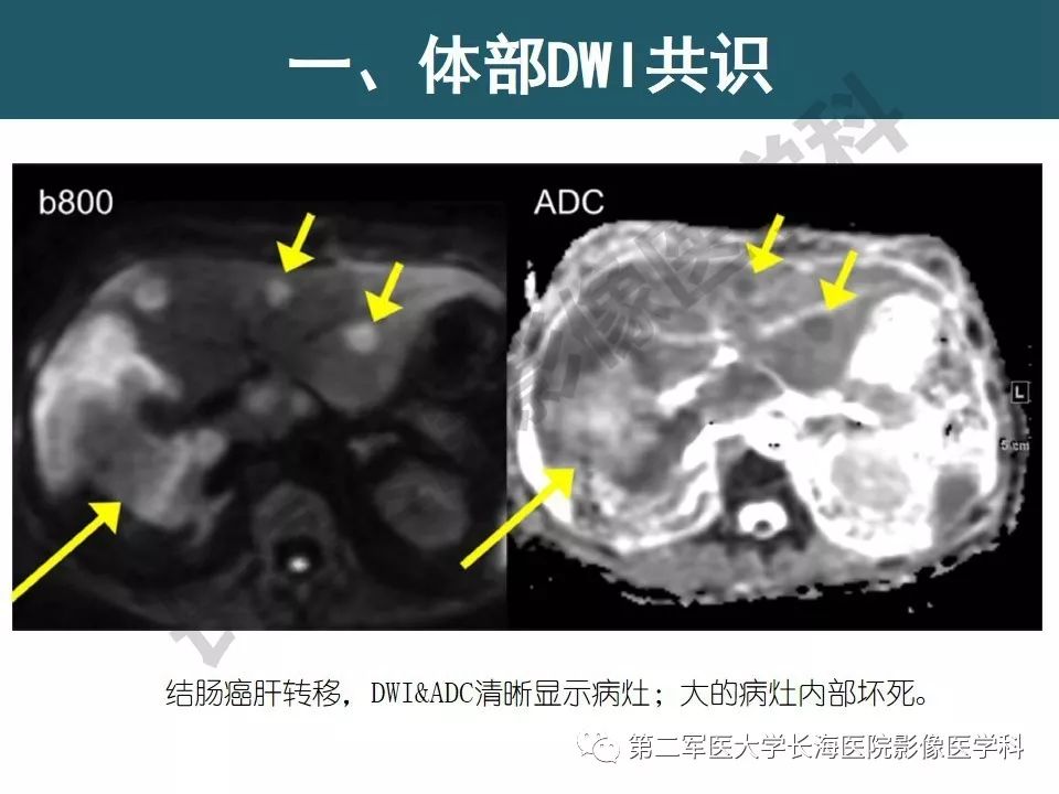 【PPT】体部DWI共识及胰腺DWI研究经验介绍