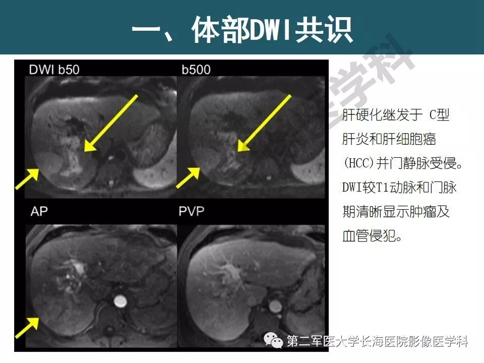 【PPT】体部DWI共识及胰腺DWI研究经验介绍