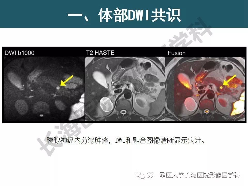 【PPT】体部DWI共识及胰腺DWI研究经验介绍