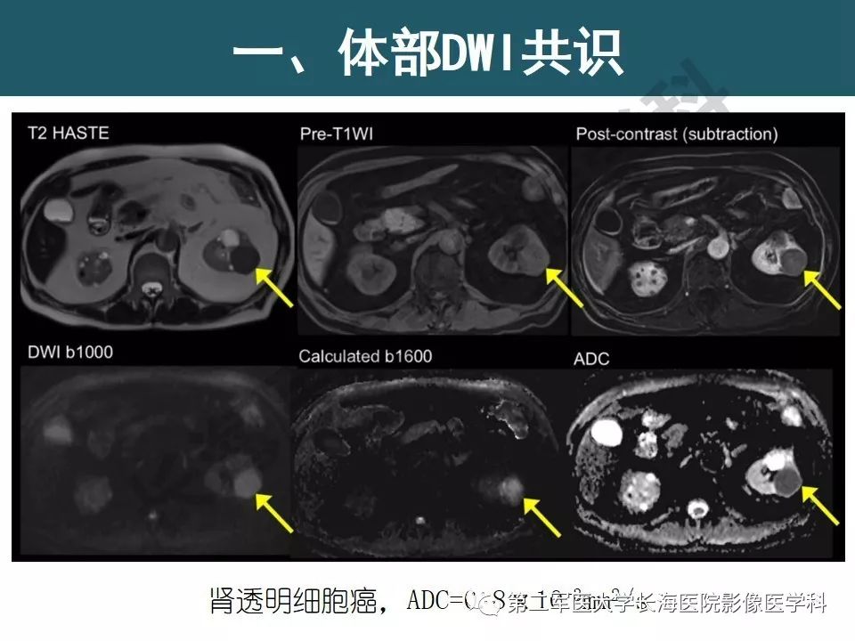 【PPT】体部DWI共识及胰腺DWI研究经验介绍