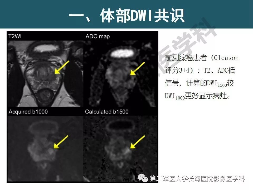 【PPT】体部DWI共识及胰腺DWI研究经验介绍