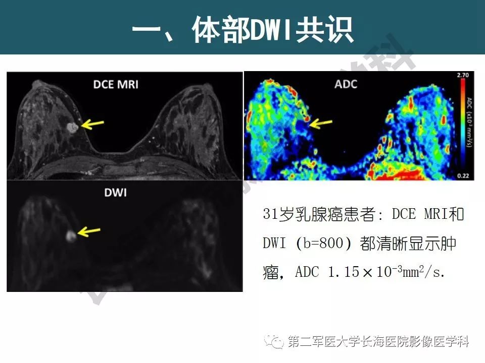 【PPT】体部DWI共识及胰腺DWI研究经验介绍