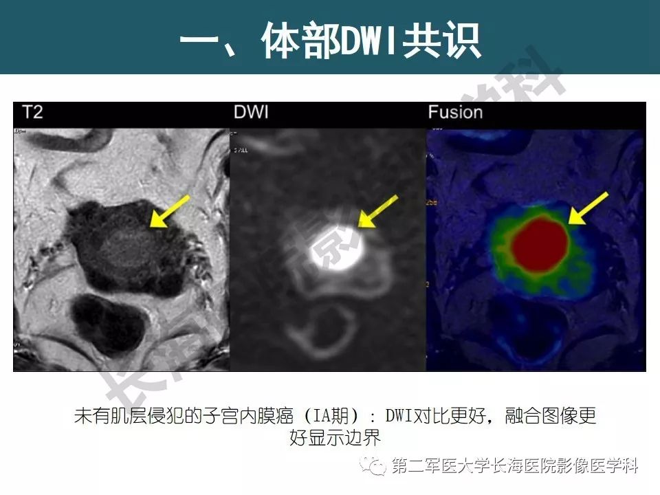 【PPT】体部DWI共识及胰腺DWI研究经验介绍