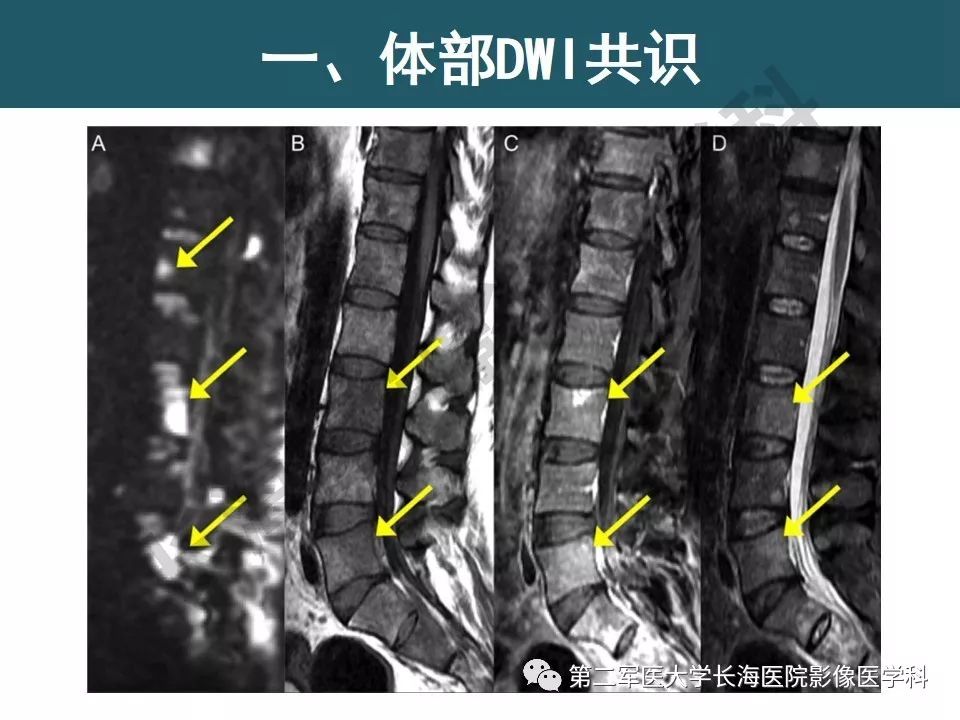【PPT】体部DWI共识及胰腺DWI研究经验介绍