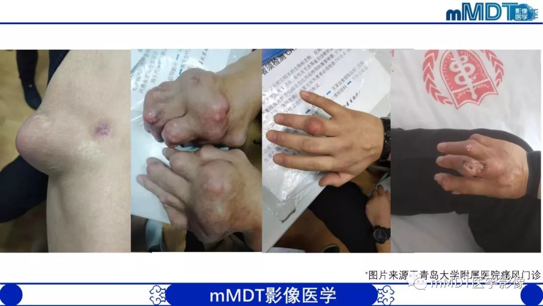 【PPT】痛风的影像学诊断与鉴别