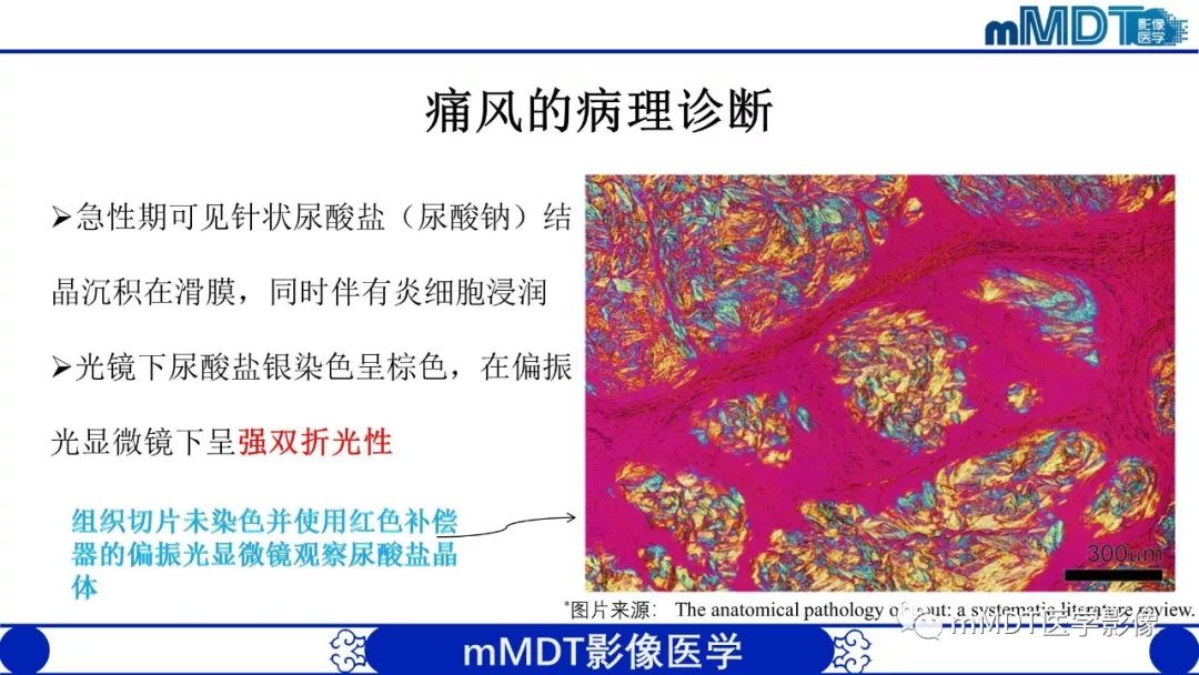 【PPT】痛风的影像学诊断与鉴别