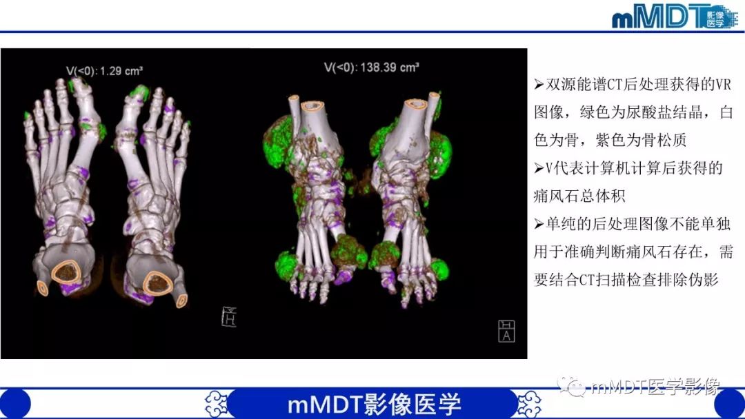 【PPT】痛风的影像学诊断与鉴别
