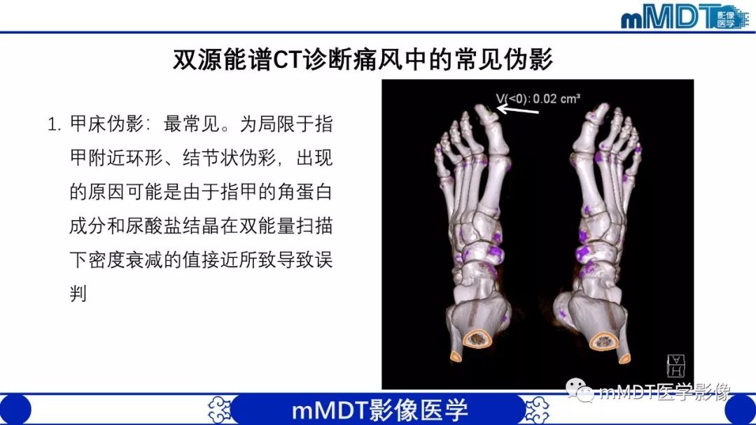 【PPT】痛风的影像学诊断与鉴别