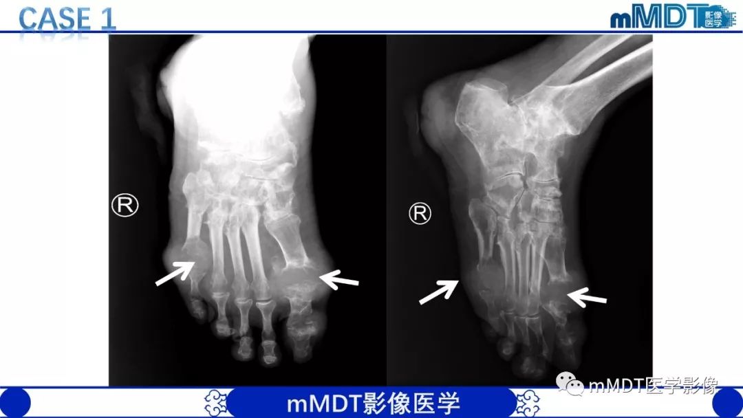 【PPT】痛风的影像学诊断与鉴别