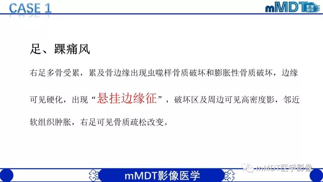 【PPT】痛风的影像学诊断与鉴别