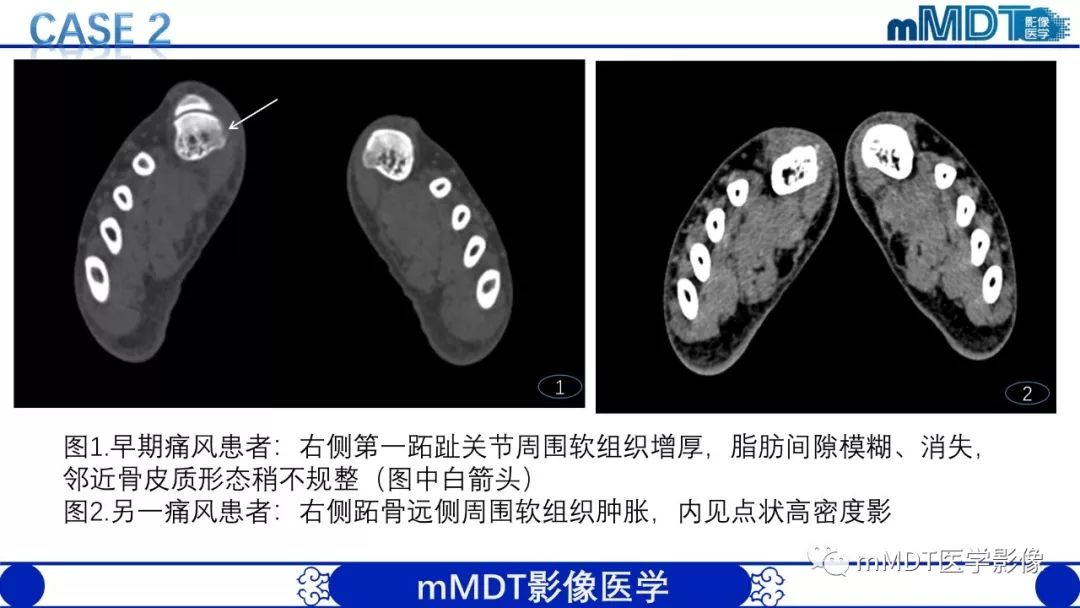 【PPT】痛风的影像学诊断与鉴别