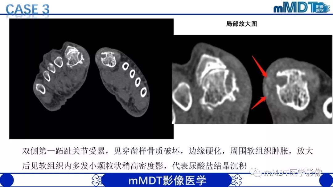 【PPT】痛风的影像学诊断与鉴别