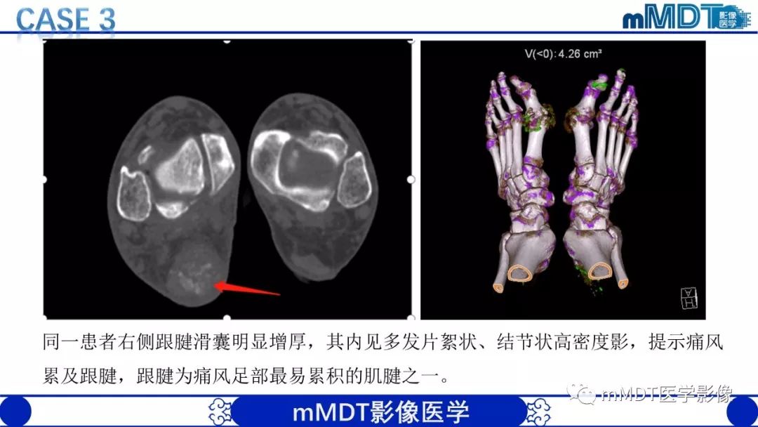 【PPT】痛风的影像学诊断与鉴别