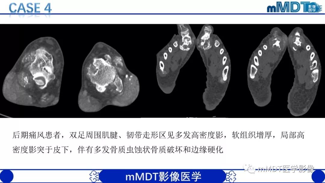 【PPT】痛风的影像学诊断与鉴别