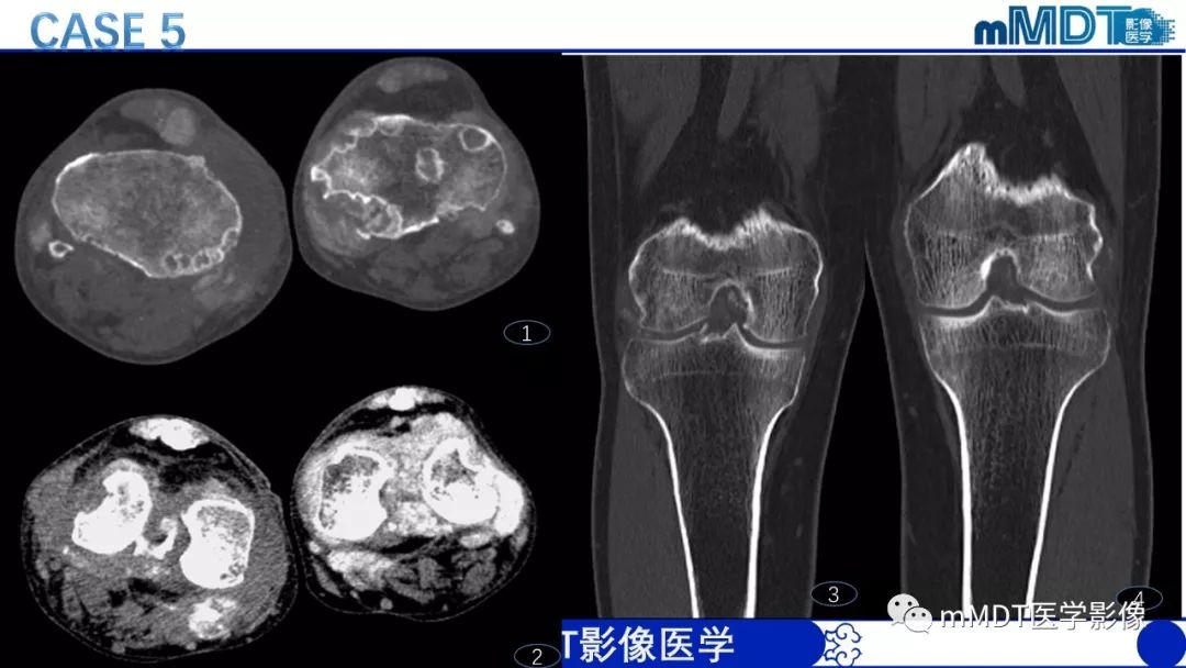 【PPT】痛风的影像学诊断与鉴别