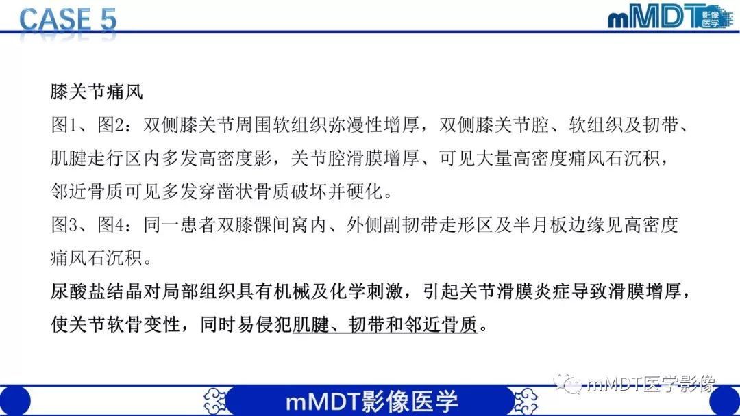 【PPT】痛风的影像学诊断与鉴别