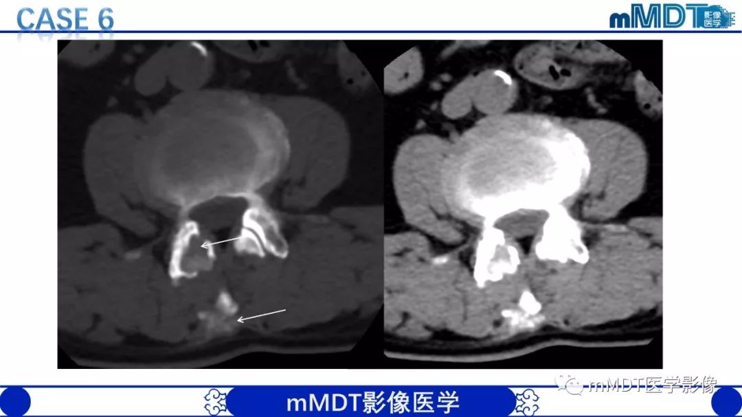【PPT】痛风的影像学诊断与鉴别