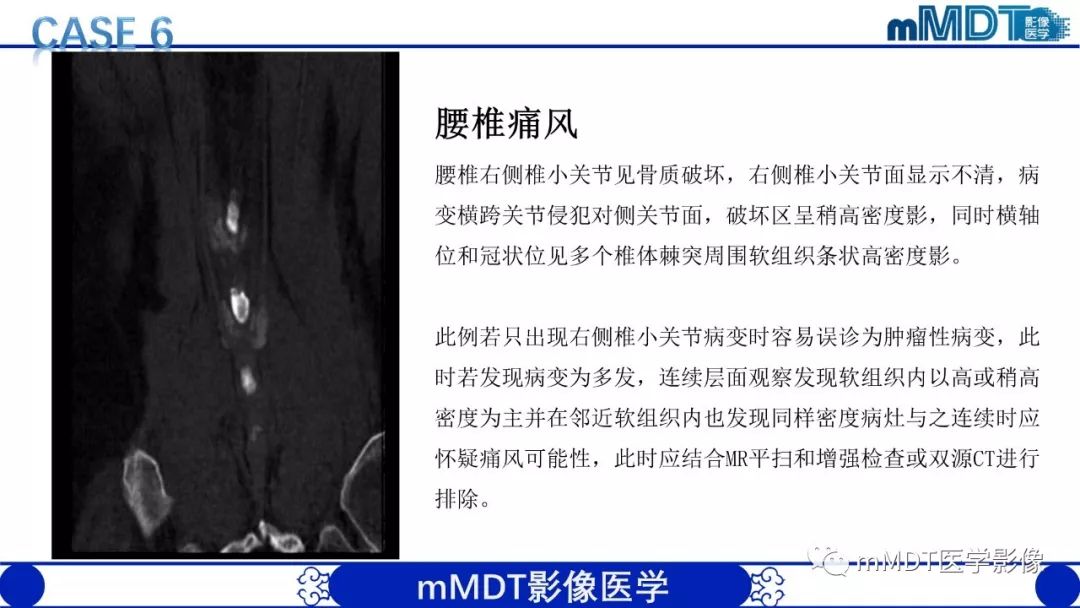 【PPT】痛风的影像学诊断与鉴别