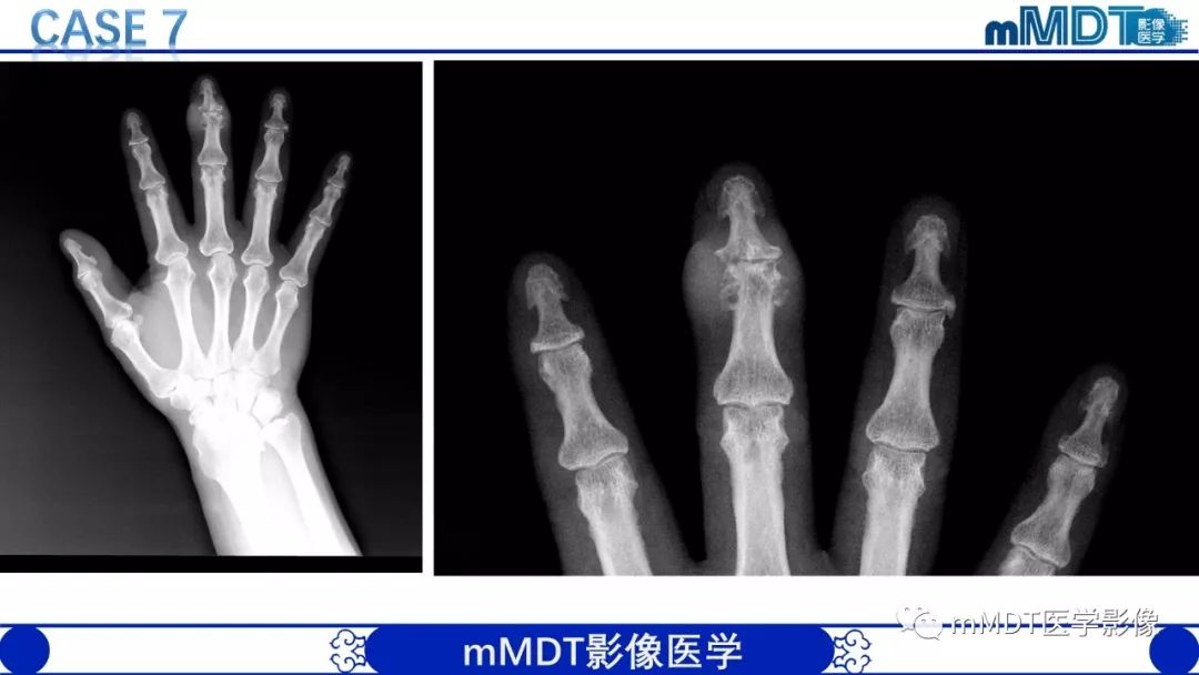 【PPT】痛风的影像学诊断与鉴别