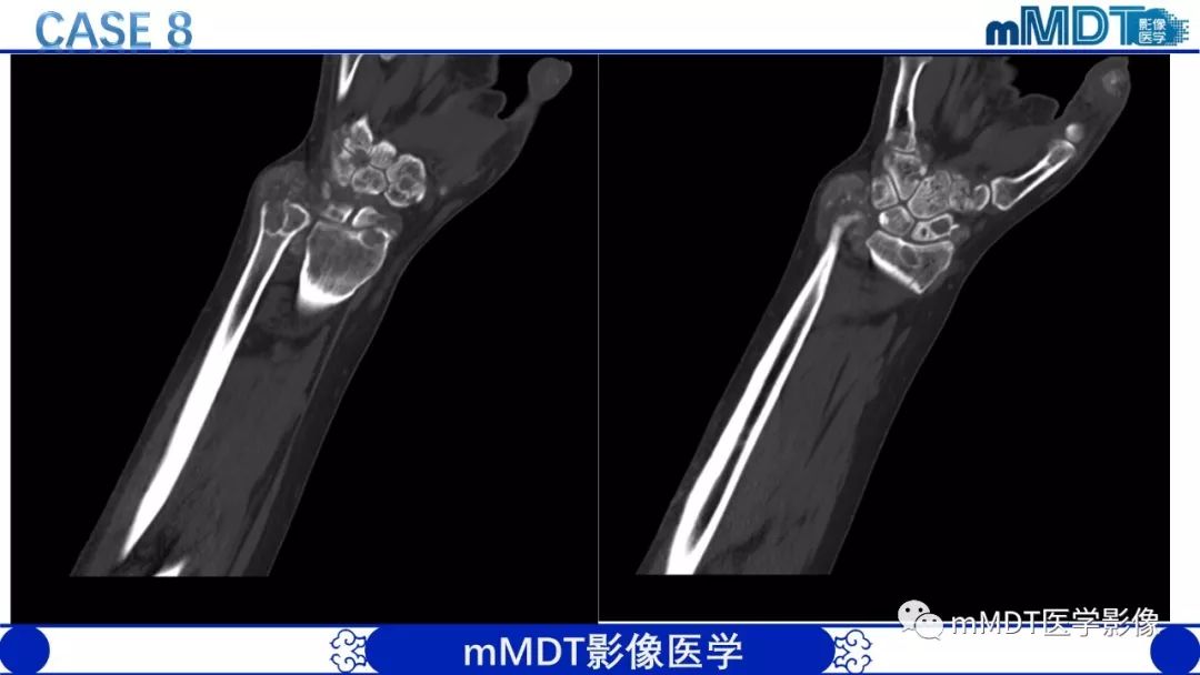 【PPT】痛风的影像学诊断与鉴别